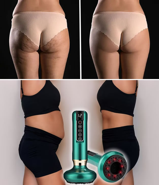 Massaggiatore a Coppettazione Anti Cellulite
