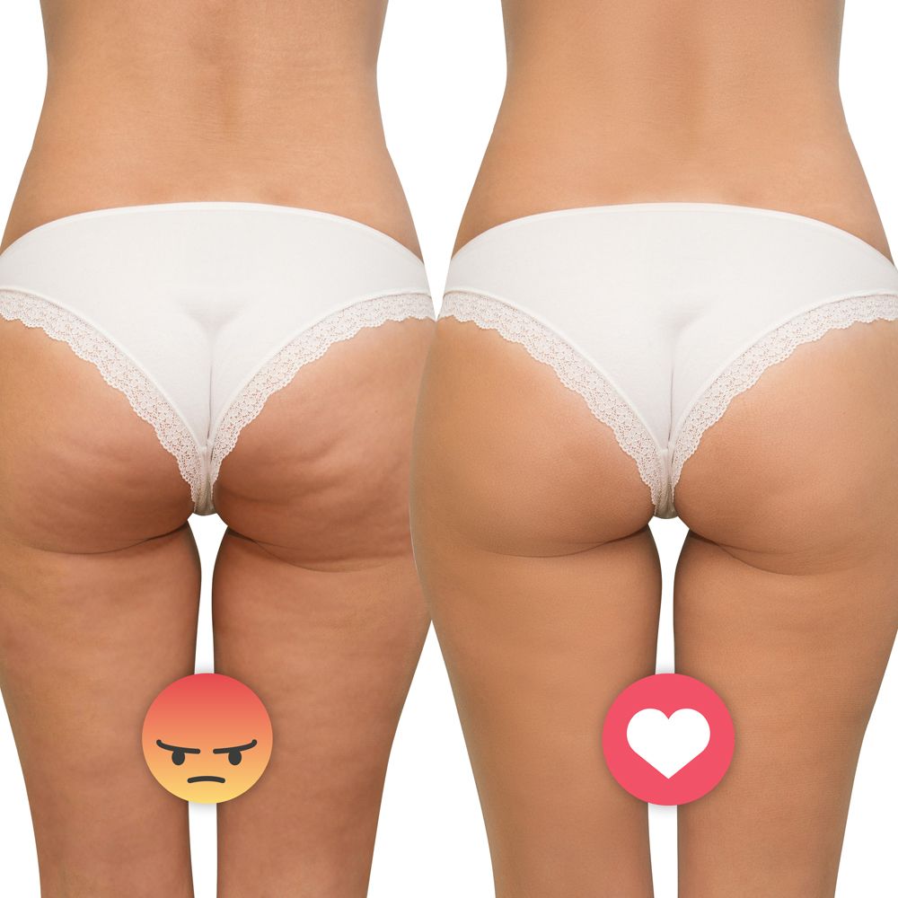 Massaggiatore anticellulite 3 in 1 ad ultrasuoni