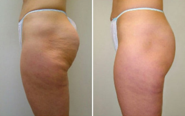 Massaggiatore corpo anticellulite e tonifica