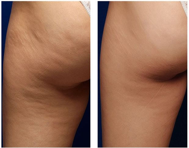 Massaggiatore corpo anticellulite e tonifica