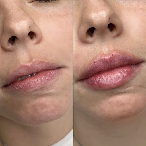 3 Flaconi Rimpolpante Labbra Naturale