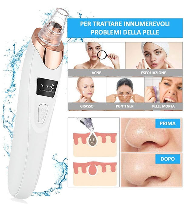 Aspiratore Acne e punti neri